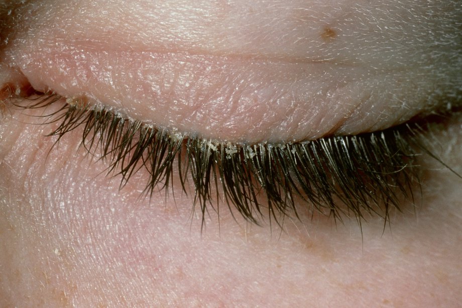 Что может служить причиной шелушения кожи вокруг глаз
