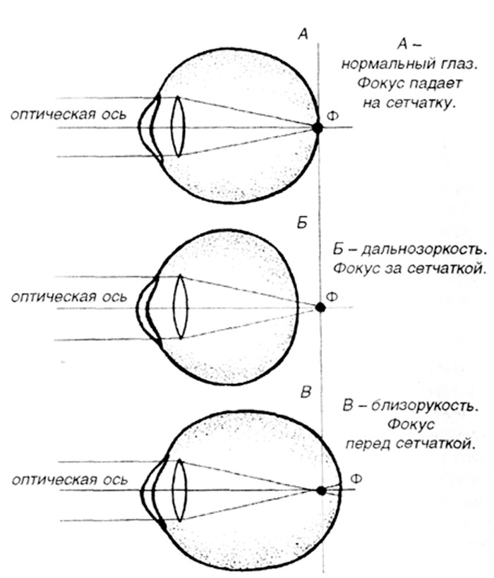 Схема близорукости и дальнозоркости