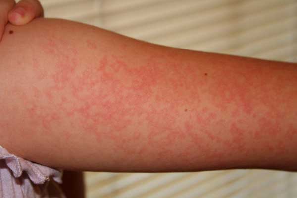 аллергия на солнце лечение симптомы