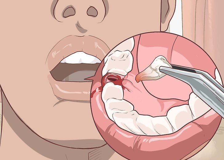 Сколько времени болит десна после удаления зуба