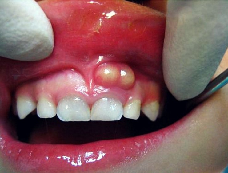 Воспаление зуба корня 