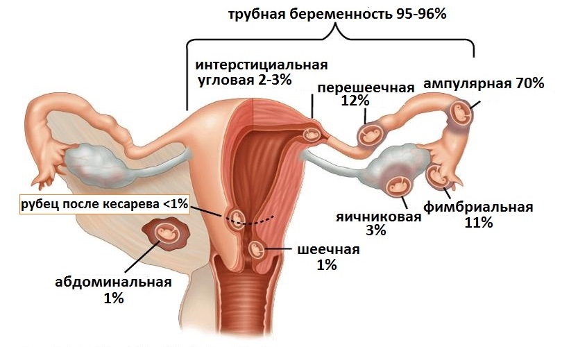 разновидности внематочной беременности